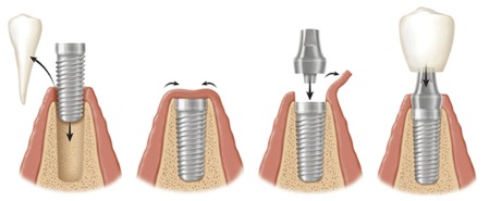 Cấu tạo của răng implant là gì? Cau-tao-cua-rang-implant-la-gi-1