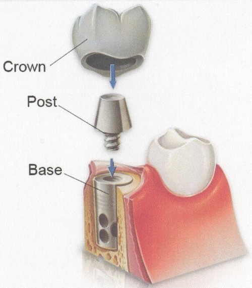 Cấu tạo của răng implant là gì? Cau-tao-cua-rang-implant-la-gi