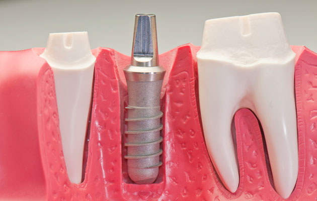 Sự phát triển cấy ghép implant nha khoa Su-phat-trien-cay-ghep2