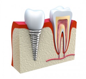 Chọn làm cầu răng hay cấy ghép implant ? Chon-lam-cau-rang-hay-cay-ghep-implant-2-300x275