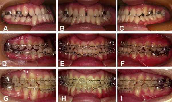 Chi phí của các phương pháp niềng răng hô vẩu Chi-phi-cua-cac-phuong-phap-nieng-rang-ho-vau-1