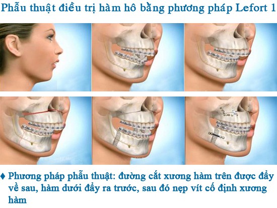 Phẫu thuật hàm hô uy tín ở chỗ nào? Phau-thuat-ham-ho-mom-va-3d-clear-2-4