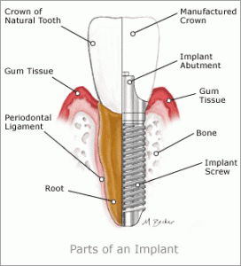 Kỹ thuật implant và các yếu tố ảnh hưởng Implant-trong-nha-khoa-272x300