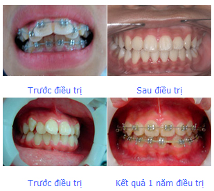 Giải pháp tốt nhất điều trị răng hô Nieng-rang-ho-2