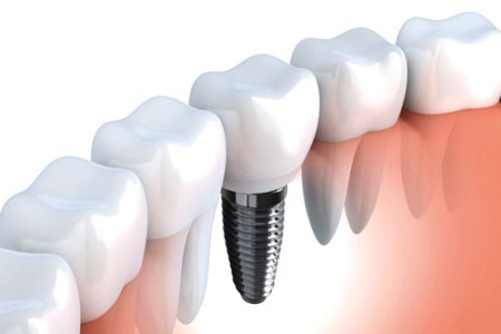 Vì sao có trường hợp cần ghép xương khi cấy implant Vi-sao-co-truong-hop-can-ghep-xuong-khi-cay-implant-01-450x300