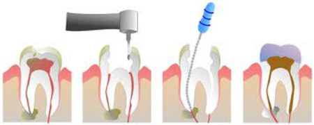 Các giai đoạn của bệnh viêm tủy và cách giải quyết Cac-giai-doan-cua-viem-tuy-va-cach-giai-quyet-01-450x180