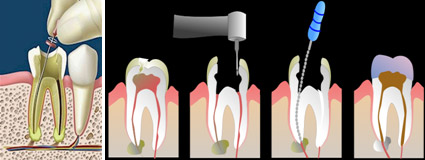 Các giai đoạn của bệnh viêm tủy và cách giải quyết Cac-giai-doan-cua-viem-tuy-va-cach-giai-quyet