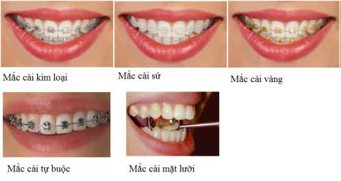 Răng có bị vàng không khi niềng răng ? Rang-co-bi-vang-khong-khi-nieng-rang-3