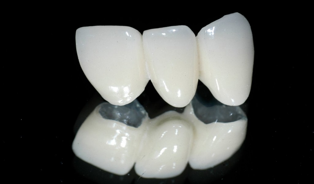 Các bước thực hiện bọc răng sứ Cac-buoc-thuc-hien-boc-rang-su-1-1024x600