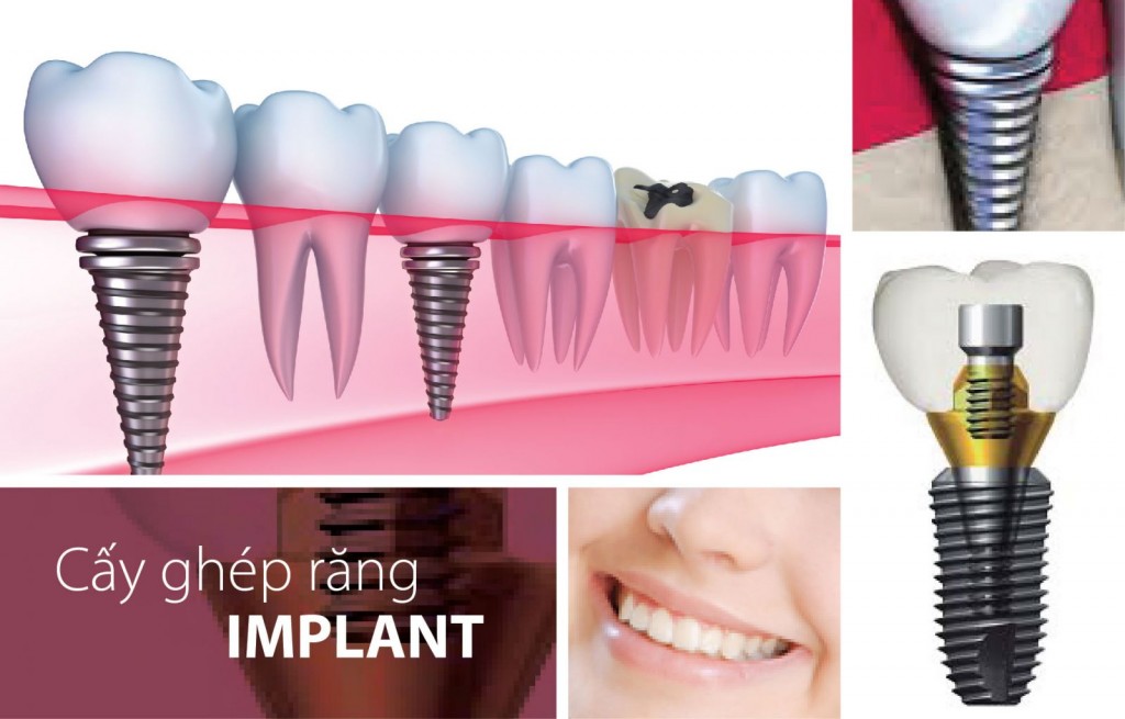 Sau khi cấy ghép Implant cần làm gì ? Sau-khi-cay-ghep-implant-can-lam-gi-2-1024x655