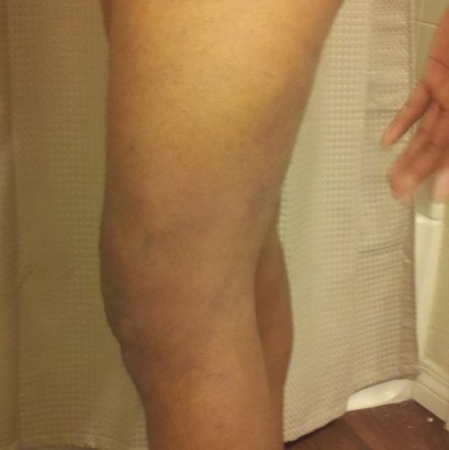 Beltran's leg(pic) 2wmnfq1