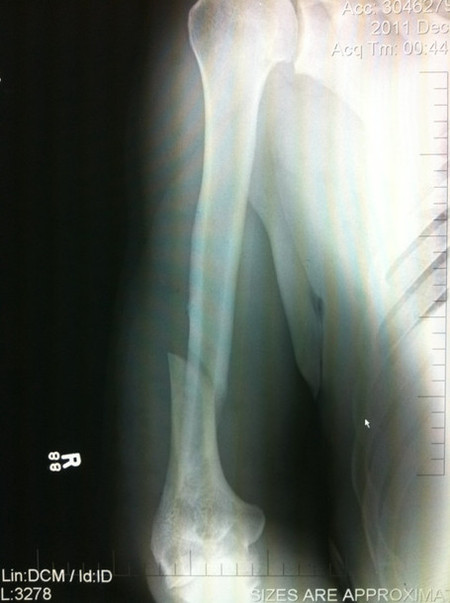 X-Ray of Antonio Rodrigo Nogueira's Broken Arm From Bout Against Frank Mir Big_nog_broken_arm_medium_large