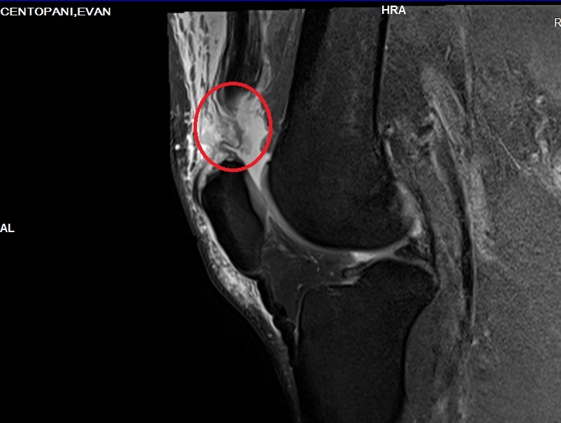 Rotura del tendon del cuadriceps Screenshot-116A