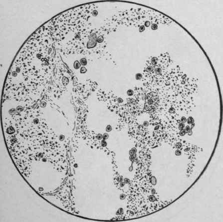 دورة التحاليل الطبية الشاملة . Stool-of-Patient-L