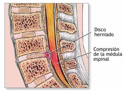 Si teneis algun problema y quereis desahogaros..... - Página 21 Hernia_disco1