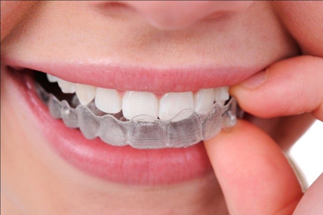 Niềng răng không mắc cài cao cấp nhất Nieng-rang-invisalign-co-tot-khong-2