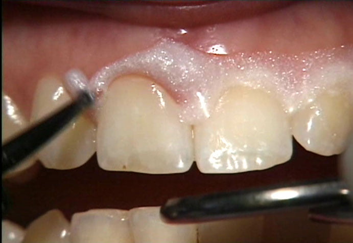 Tẩy trắng răng có an toàn không ? Tay-trang-rang-co-an-toan-khong