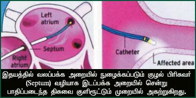 அறுவை சிகிச்சையின்றி இதய சிகிச்சை A2-3