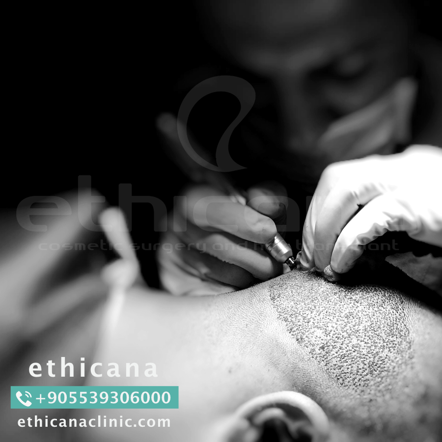 اثيكانا لزراعة الشعر في تركيا - اسطنبول | ethicana P_423m1hze4