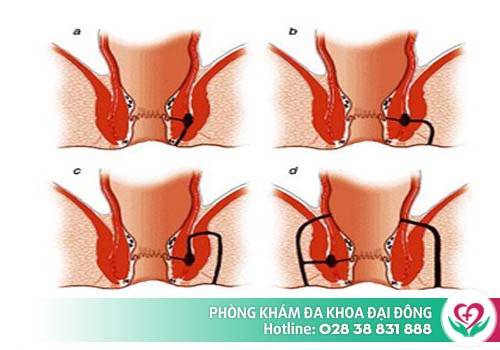 Tìm hiểu về bệnh rò hậu môn Ro-hau-mon