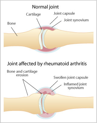Scientists target mechanism for cell death to prevent rheumatoid arthritis Juvenile-Rheumatoid-Arthritis