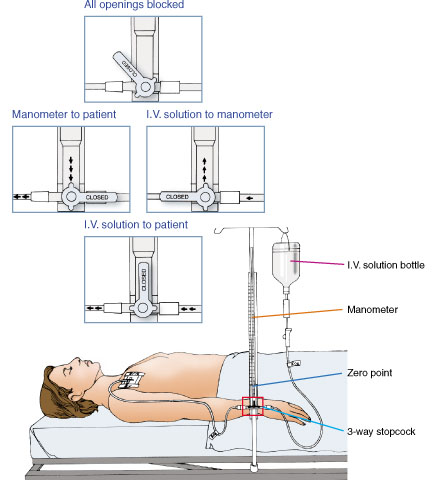 Pemasangan Central Venous Pressure (CVP) 3a_01