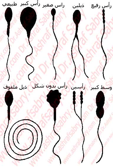 بعض اسباب تشوه النطاف لدى الرجل 61-c4-abnormal-sperm