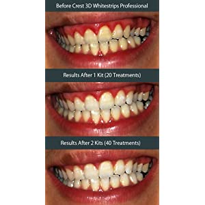 The Myths of Teeth Whitening Exposed 61SJ9HPYynL._AA300_