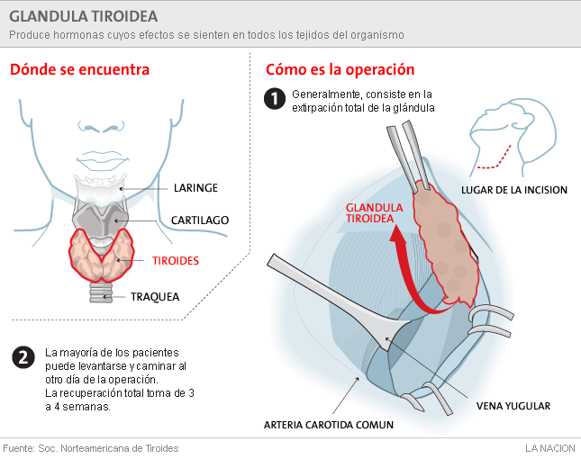 Chávez: Algo extraño está pasando con la salud de líderes progresistas de América Latina - Página 2 Info_tiroides