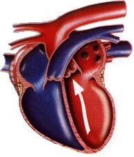 Insuffisance cardiaque chez le chien Cardiomyopathie_dilatee