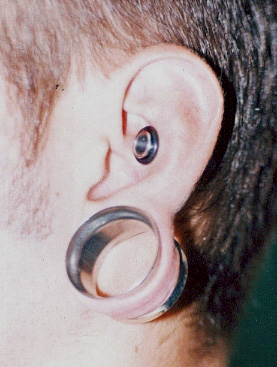 Le topic Piercings/Tatoos Plastic-surgery-repair-of-ear-gauging-indianapolis-dr-barry-eppley