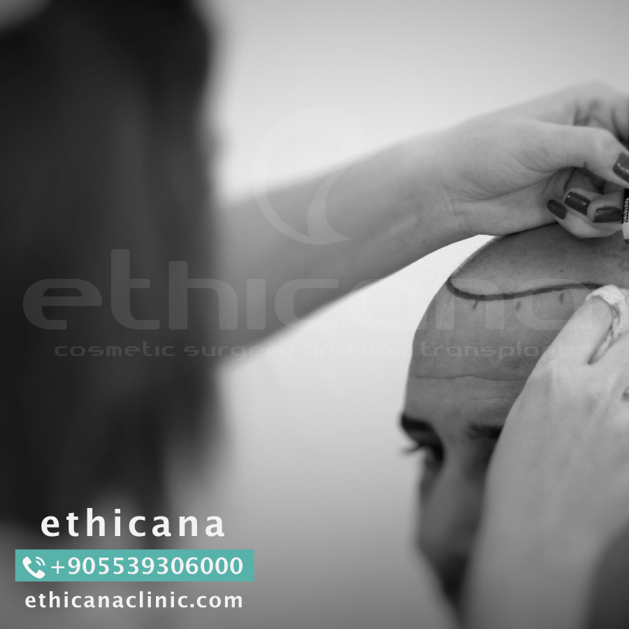 اثيكانا لزراعة الشعر في تركيا - اسطنبول | ethicana P_423xy1oe6