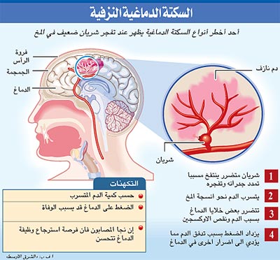 أربع مسببات للسكتة الدماغية عند الرجال 1212020608388GqG