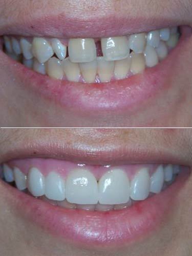 تجميـــل الأسنـــان بالفيـــنــيــر veneer أســـرع من التقويم Hwaml.com_1295975943_201