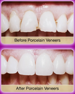 تجميـــل الأسنـــان بالفيـــنــيــر veneer أســـرع من التقويم Hwaml.com_1295975945_115