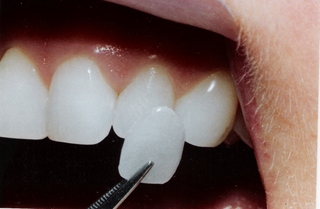  Thumbs up تجميـــل الأسنـــان بالفيـــنــيــر veneer أســـرع من التقويم  Hwaml.com_1295975945_164