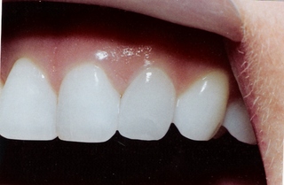  Thumbs up تجميـــل الأسنـــان بالفيـــنــيــر veneer أســـرع من التقويم  Hwaml.com_1295975945_939