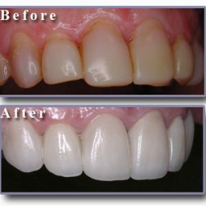  Thumbs up تجميـــل الأسنـــان بالفيـــنــيــر veneer أســـرع من التقويم  Hwaml.com_1295975948_494