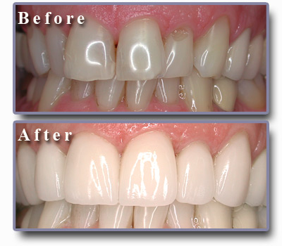 تجميـــل الأسنـــان بالفيـــنــيــر veneer أســـرع من التقويم Hwaml.com_1295975949_793