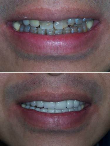 تجميـــل الأسنـــان بالفيـــنــيــر veneer أســـرع من التقويم Hwaml.com_1295976053_217