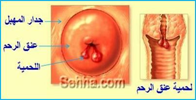 ملف كامل عن الإلتهابات المهبلية Hwaml.com_1308939765_279