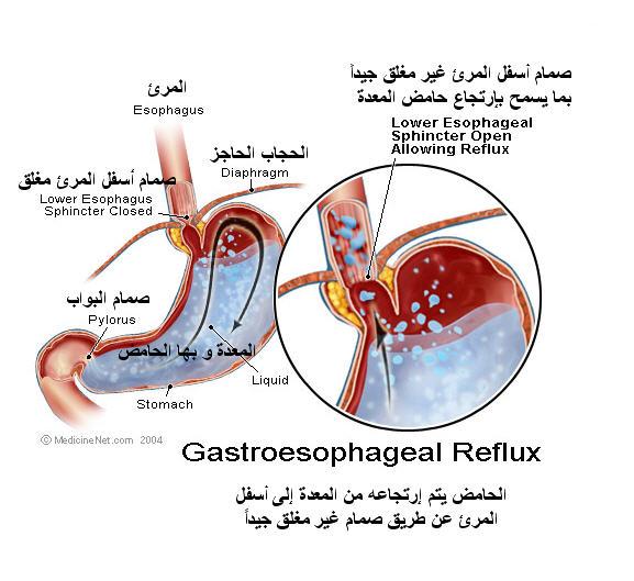  حرقة المعدة، حرقة الفؤاد، ارتجاع المريء Hwaml.com_1315749772_421