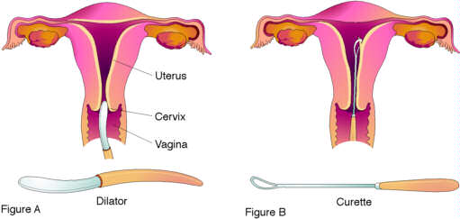 عملية( الكورتاج ) او تنظيف الرحم اللي ماتعرف عنها تدخل ؟ Hwaml.com_1334467853_798