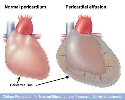 بحث طبي عن التهاب غلاف القلب ، اسباب التهاب غلاف القلب ، علاج التهاب غلاف القلب Hwaml.com_1346547562_652