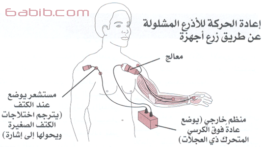 اسباب إصابات الحبل الشوكي ، علاج إصابات الحبل الشوك Hwaml.com_1347411232_782