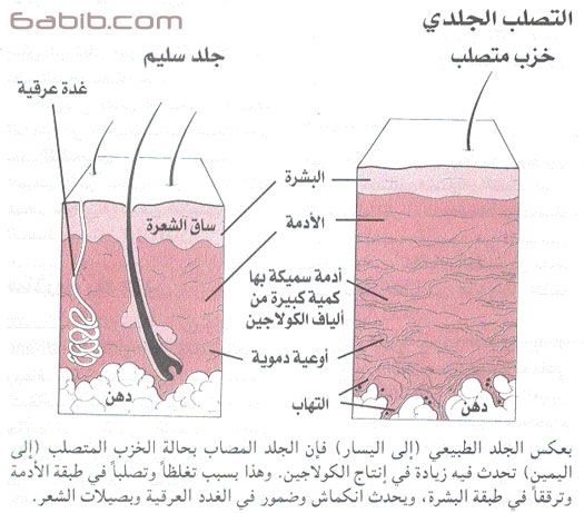  اسباب تصلب الجلد ، علاج تصلب الجلد  Hwaml.com_1347669950_375