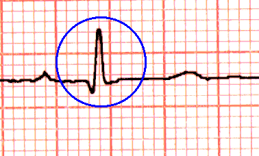 le language et la lecture de l'ECG CompQRS