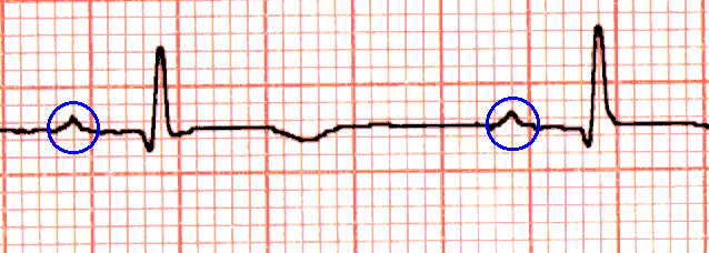 le language et la lecture de l'ECG OndeP