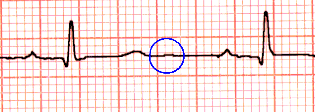 le language et la lecture de l'ECG OndeU