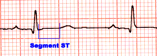 le language et la lecture de l'ECG SegST